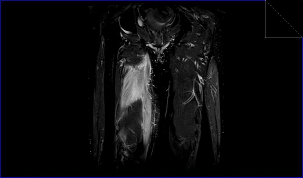 Infectious Myositis MRI | Radiology article on Infectious Myositis