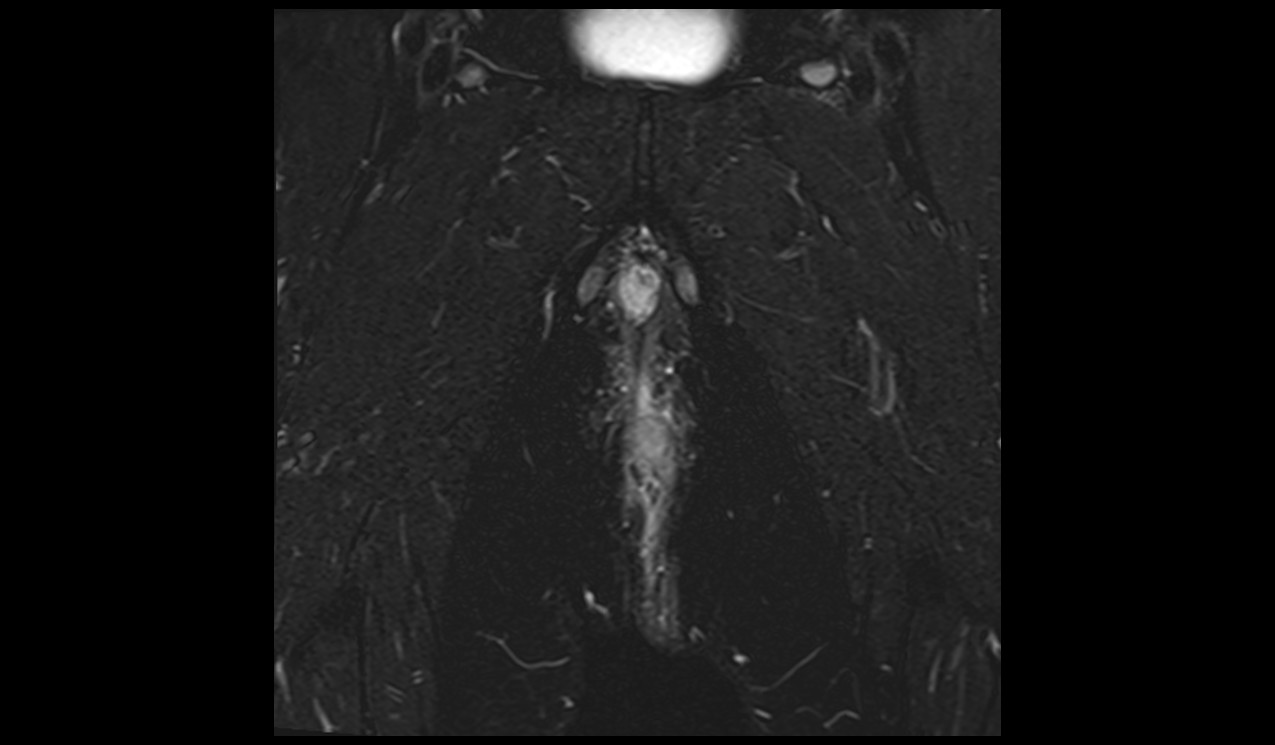 Perianal fistula MRI | Radiology article on Perianal fistula MRI