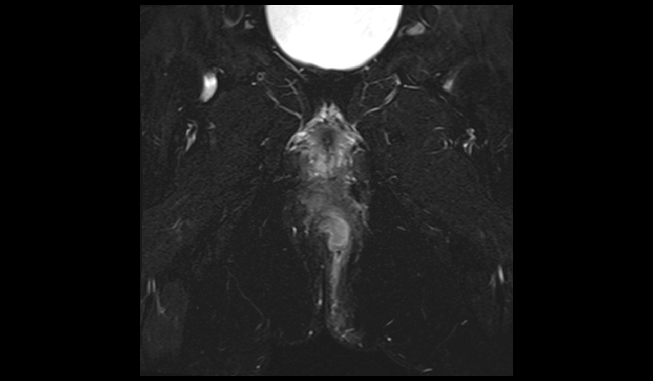 Perianal fistula MRI | Radiology article on Perianal fistula MRI