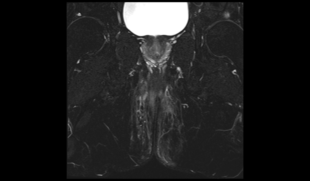 Perianal fistula MRI | Radiology article on Perianal fistula MRI