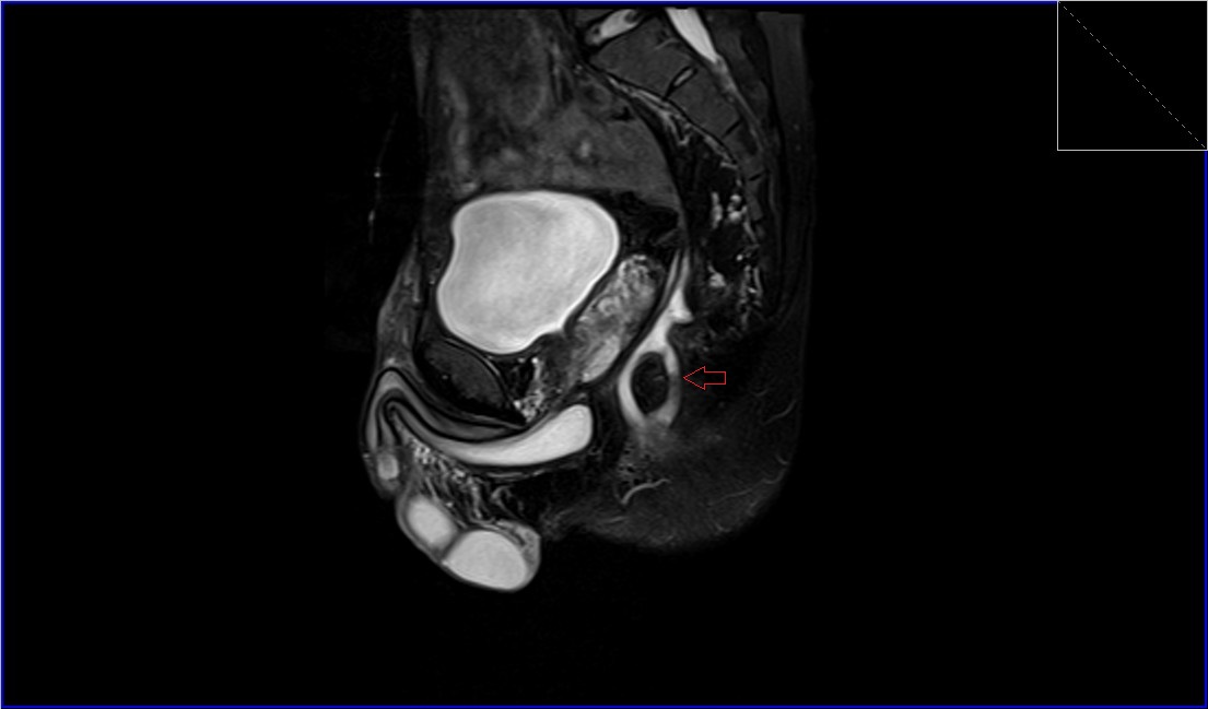 Perianal fistula MRI | Radiology article on Perianal fistula MRI