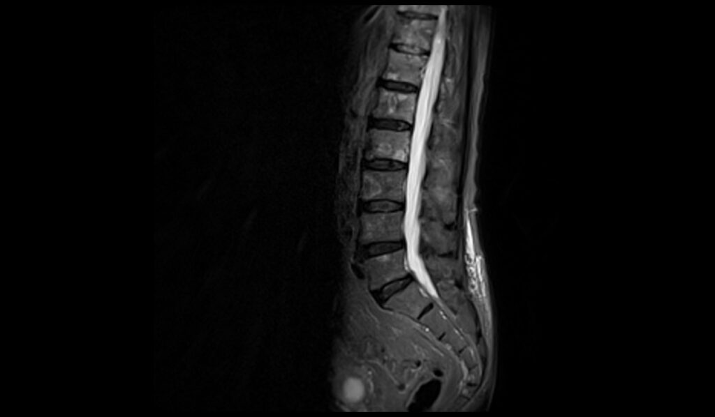 Spinal metastases MRI | Radiology article on spinal metastases