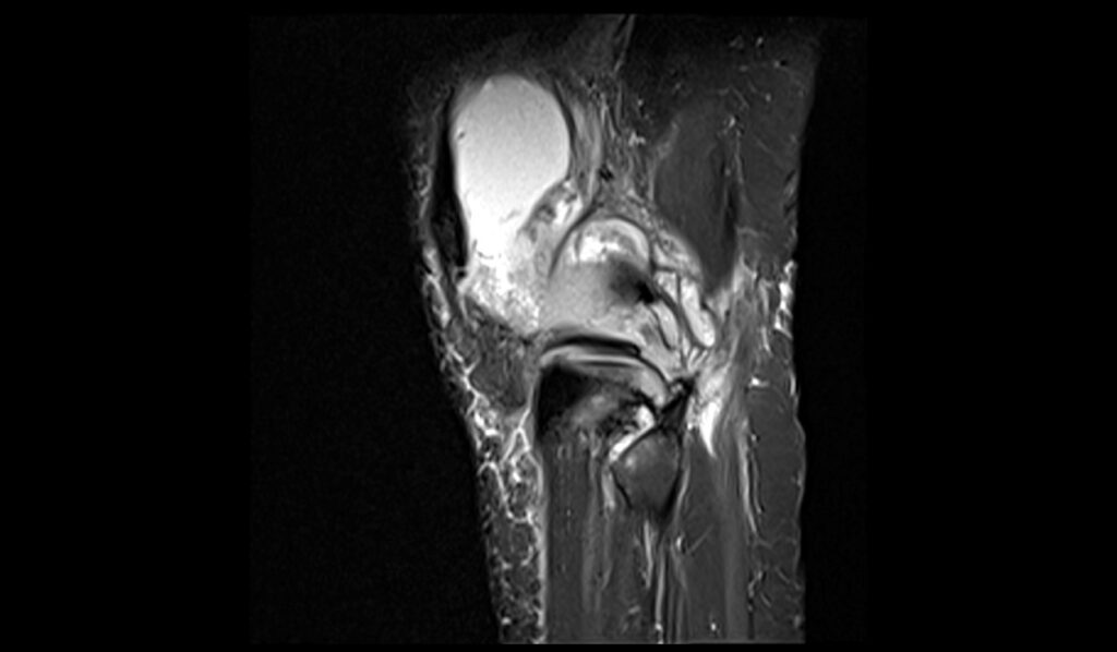 Knee Synovitis MRI| Radiology Article on Knee Synovitis