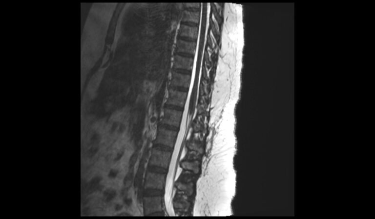 CISS MRI sequence | FIESTA-C MRI | phase balanced sarge | PBSG physics ...