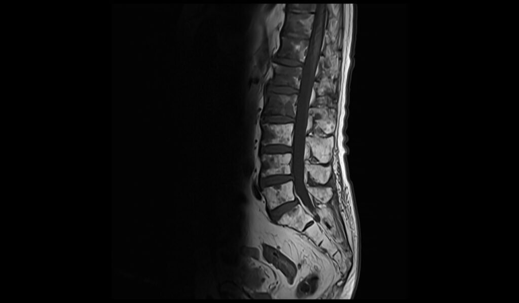 T1 Appearance of Spinal Metastases