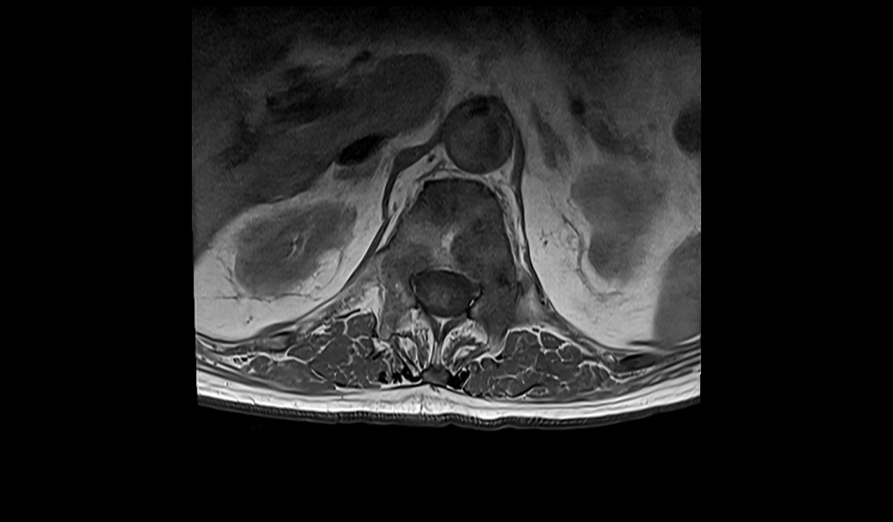 Spinal metastases MRI | Radiology article on spinal metastases