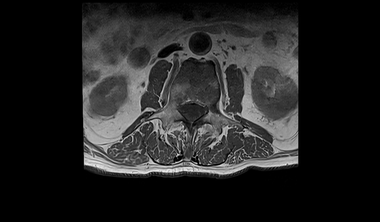 Spinal metastases MRI | Radiology article on spinal metastases