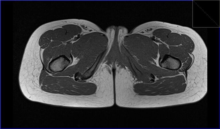 Hamstring Injury MRI | Radiology article on Hamstring Injury