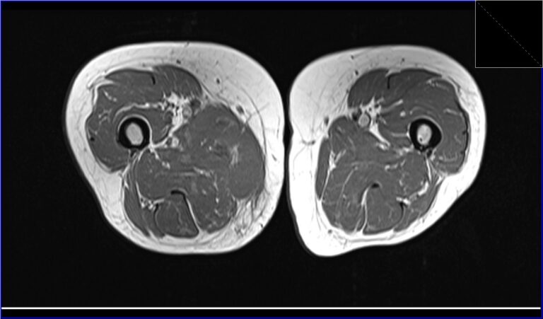 Infectious Myositis MRI | Radiology article on Infectious Myositis