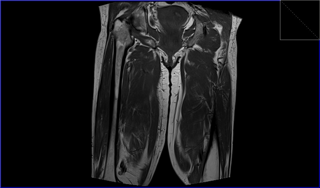 Infectious Myositis MRI | Radiology article on Infectious Myositis