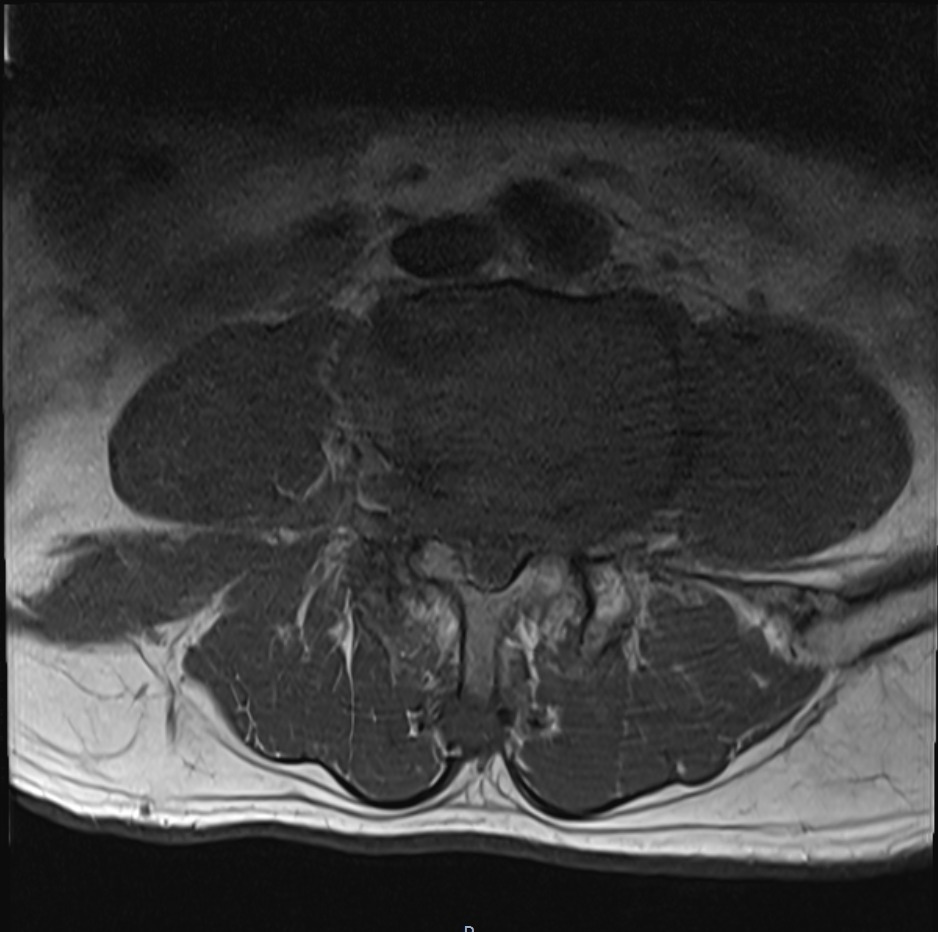 MRI Cauda equina syndrome | Radiology article on Cauda equina syndrome ...