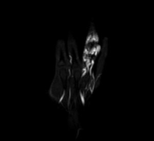 Hand Arteriovenous Malformations MRI | Radiology article on hand AVM