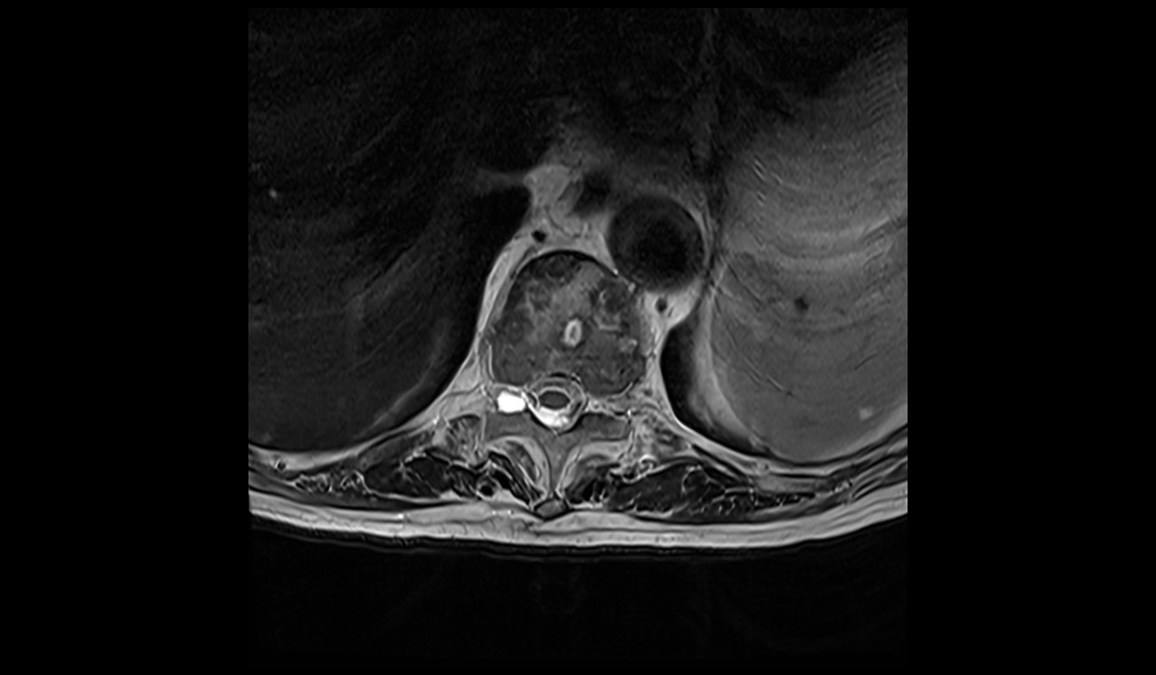 Spinal metastases MRI | Radiology article on spinal metastases