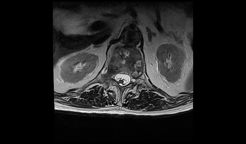 Spinal metastases MRI | Radiology article on spinal metastases