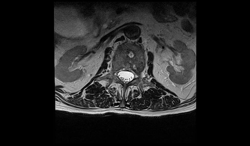 Spinal metastases MRI | Radiology article on spinal metastases