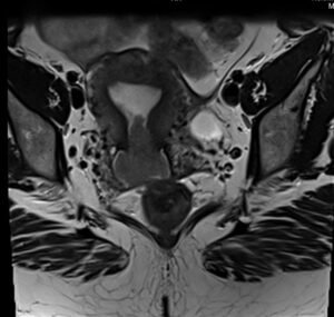 MRI Cervical cancer | Radiological Insights into Imaging for Cervical ...