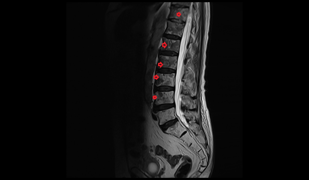 Spinal metastases MRI | Radiology article on spinal metastases