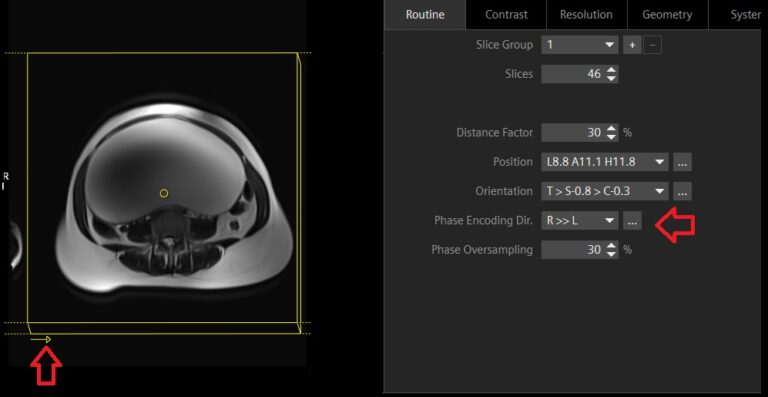 Phase encoding in MRI | MRI Phase encoding direction