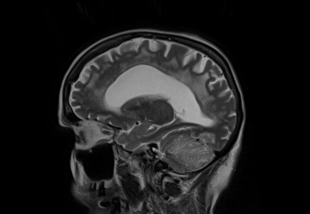 MRI Dysplastic cerebellar gangliocytoma (Lhermitte-Duclos disease)