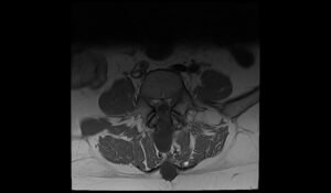 CSF leak MRI | Radiology article on CSF leak