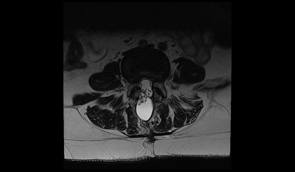 Csf Leak Mri 