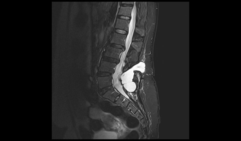 CSF leak MRI | Radiology article on CSF leak