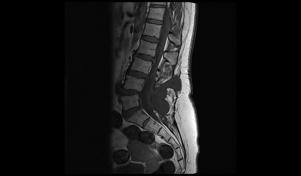 CSF leak MRI | Radiology article on CSF leak