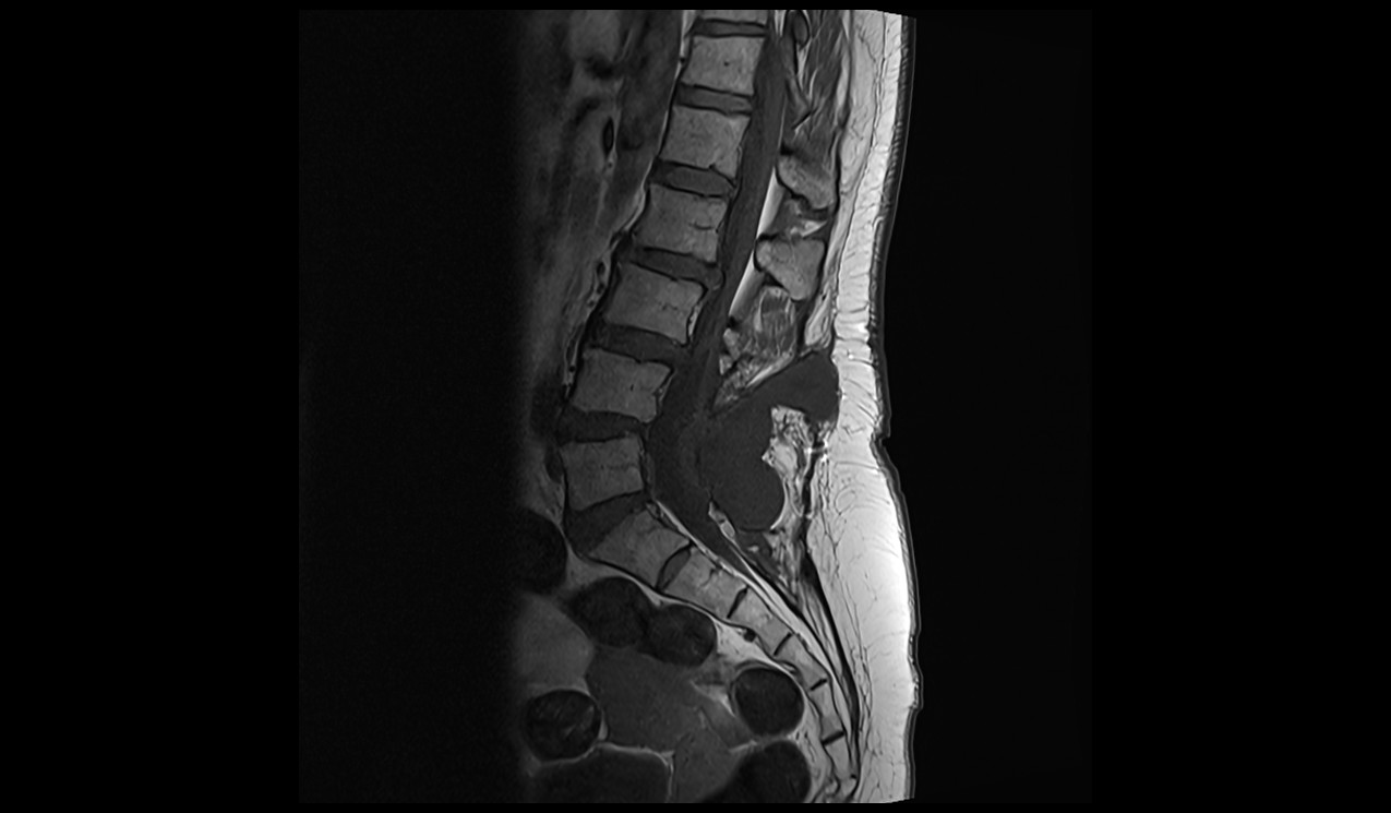 CSF leak MRI | Radiology article on CSF leak