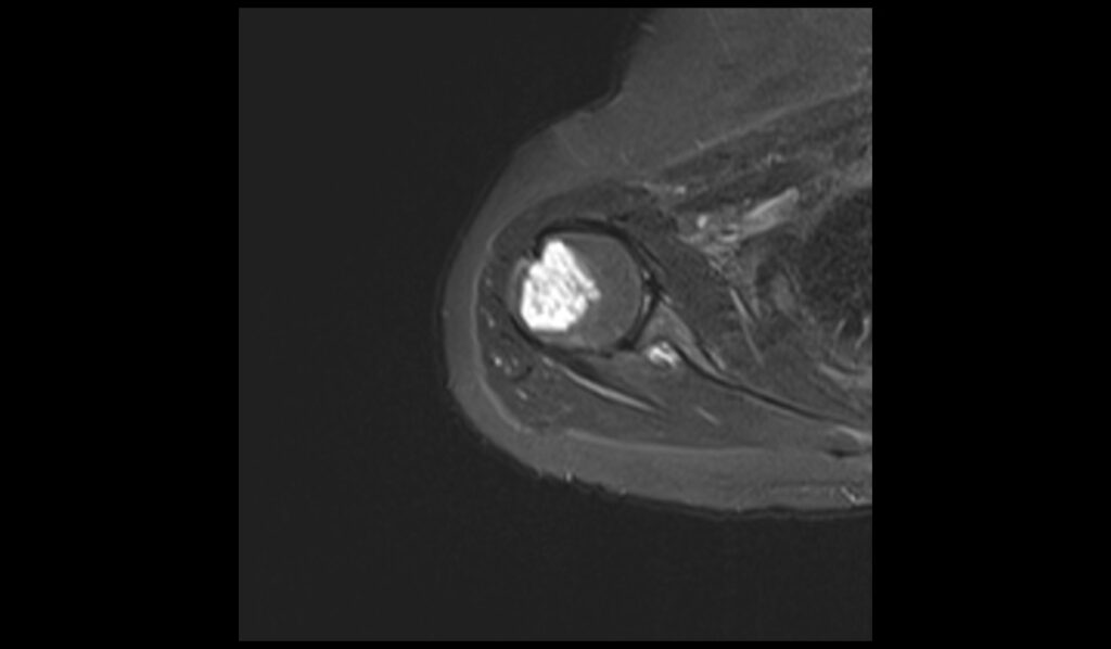 Enchondroma MRI | Radiology Article on Enchondroma MRI