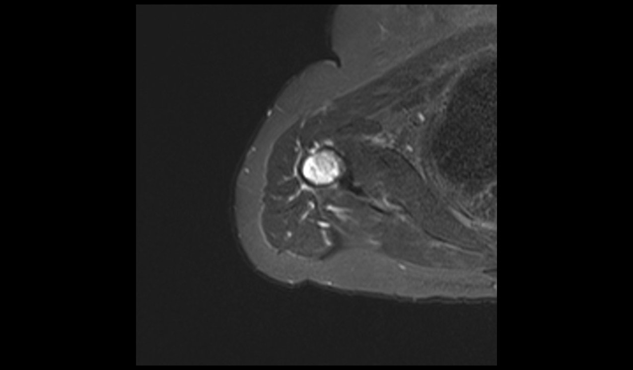 Enchondroma MRI | Radiology Article on Enchondroma MRI