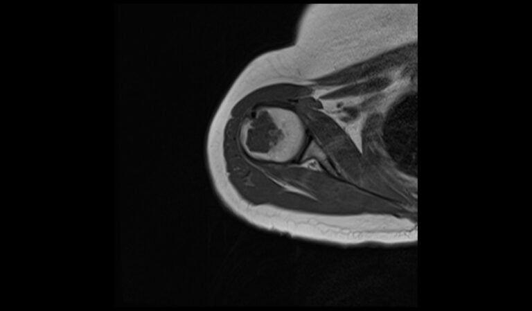 Enchondroma MRI | Radiology Article on Enchondroma MRI