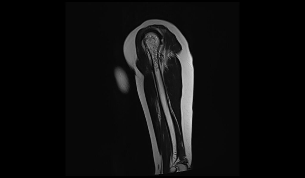 Enchondroma MRI | Radiology Article on Enchondroma MRI