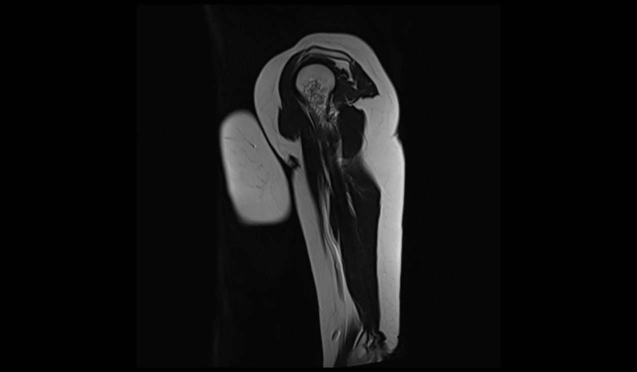 Enchondroma MRI | Radiology Article on Enchondroma MRI
