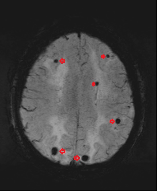 Swi Mri Susceptibility Weighted Imaging Swi