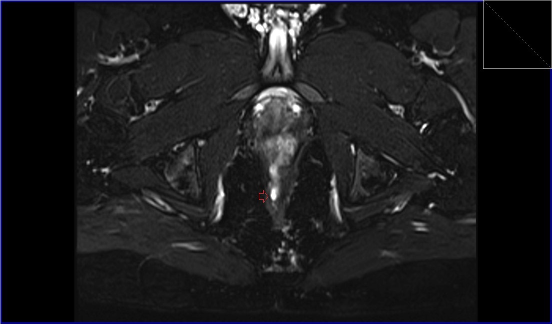 Perianal fistula MRI | Radiology article on Perianal fistula MRI