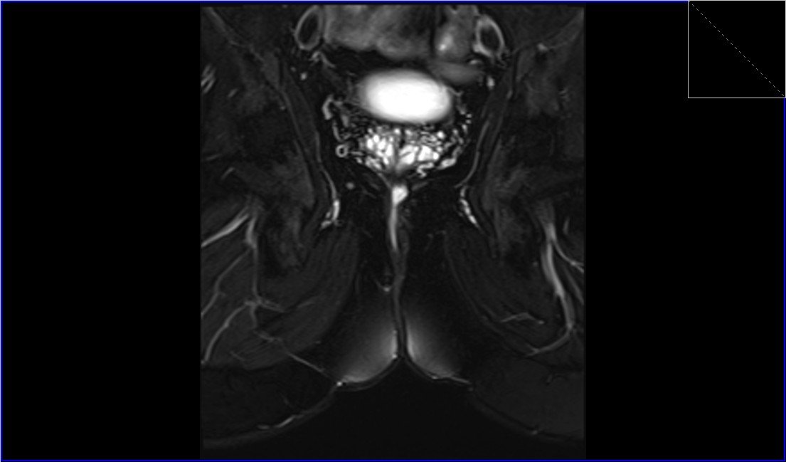 stir coronal oblique image of pelvis shows Perianal Fistula. stir coronal oblique image of pelvis shows Perianal Fistula.