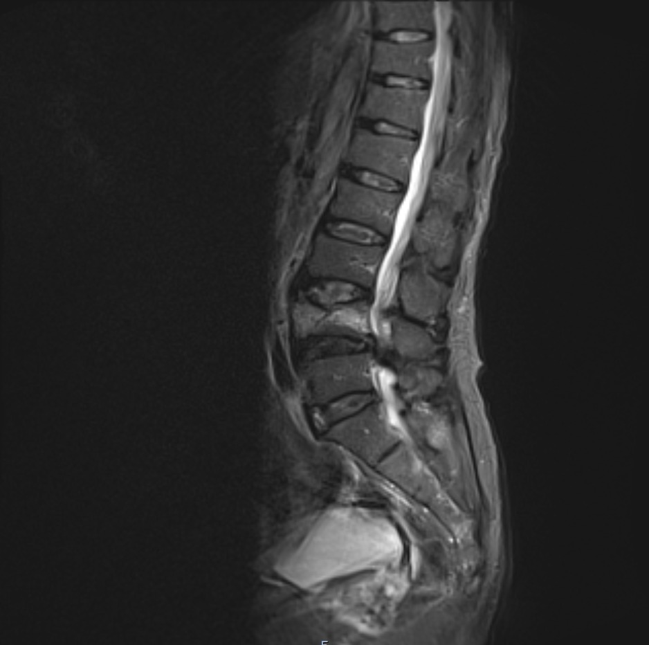 MRI Cauda equina syndrome | Radiology article on Cauda equina syndrome ...