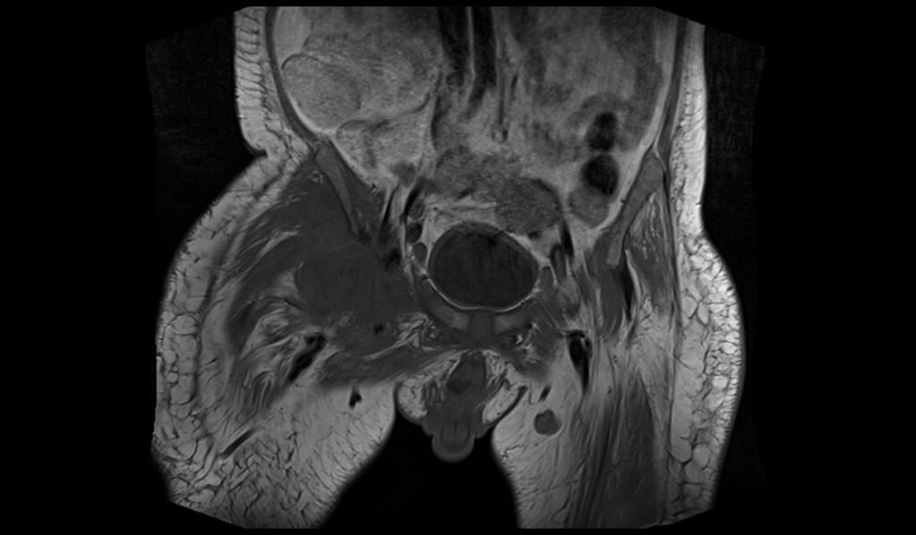 t1 coronal image of pelvis shows pelvic osteomyelitis 1