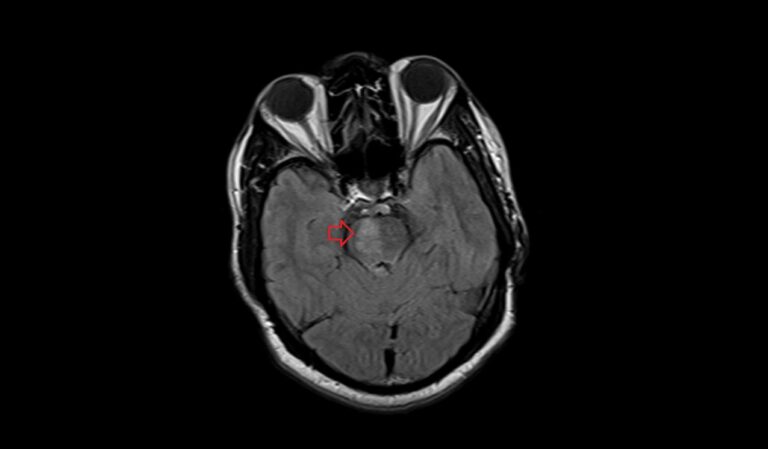 Acute pontine infarct MRI | Radiology Article on pontine stroke