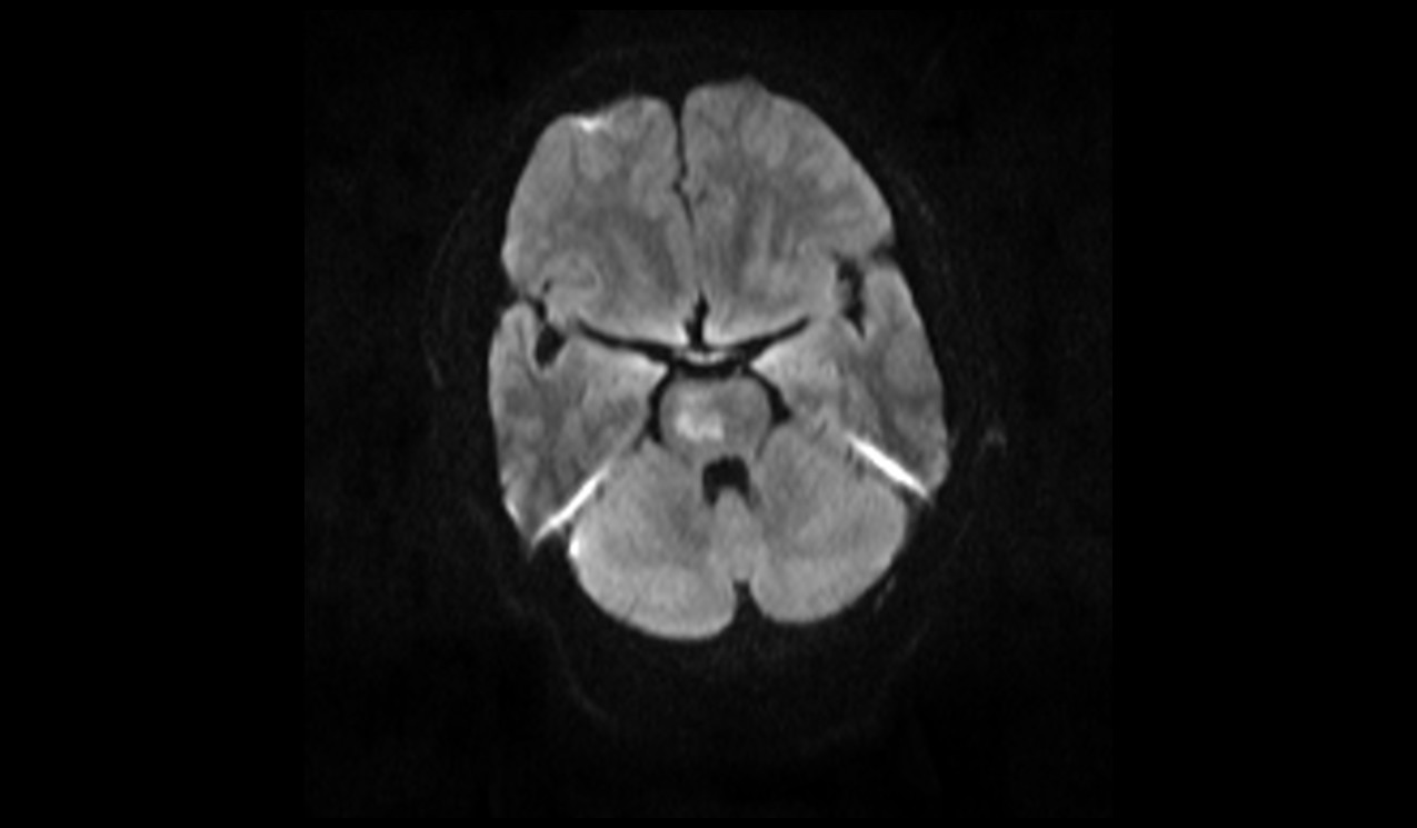 Acute pontine infarct MRI | Radiology Article on pontine stroke