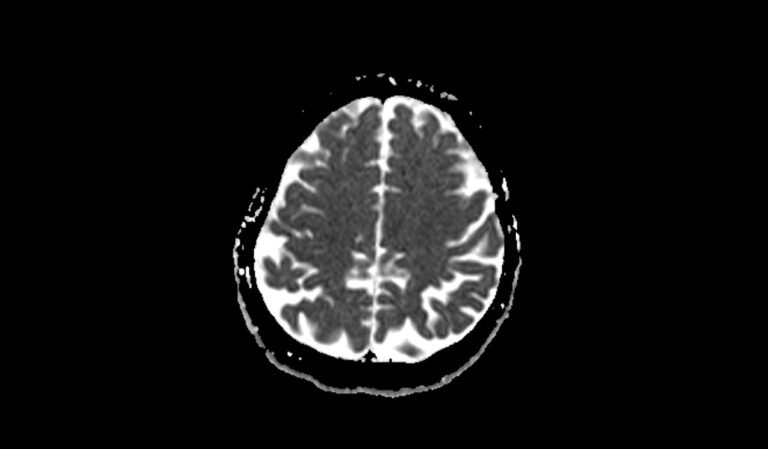 Magnims Score Multiple sclerosis(MS) MRI | Radiology Article on Multiple sclerosis