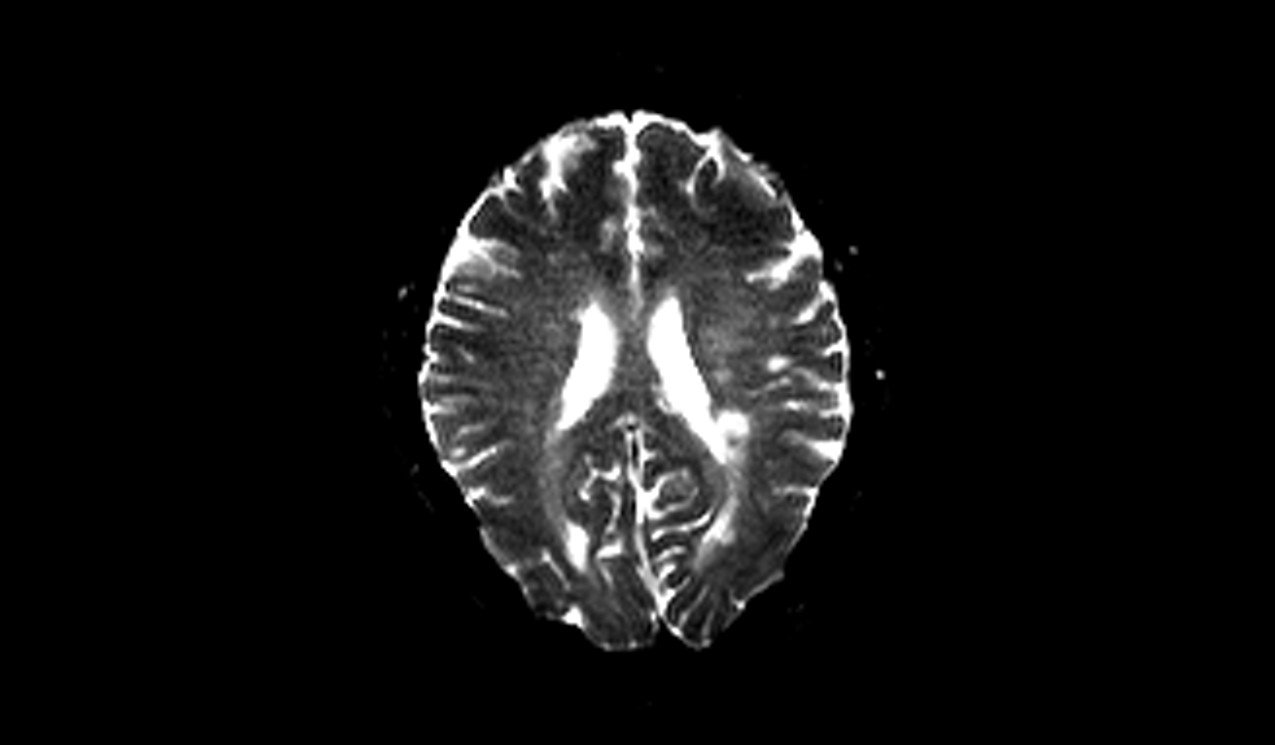 Multiple sclerosis(MS) MRI | Radiology Article on Multiple sclerosis