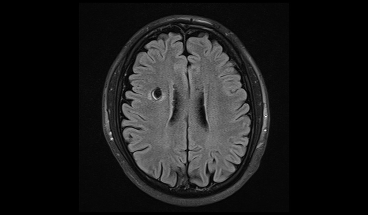 Cavernoma MRI | Radiology Article on Cavernous Hemangioma