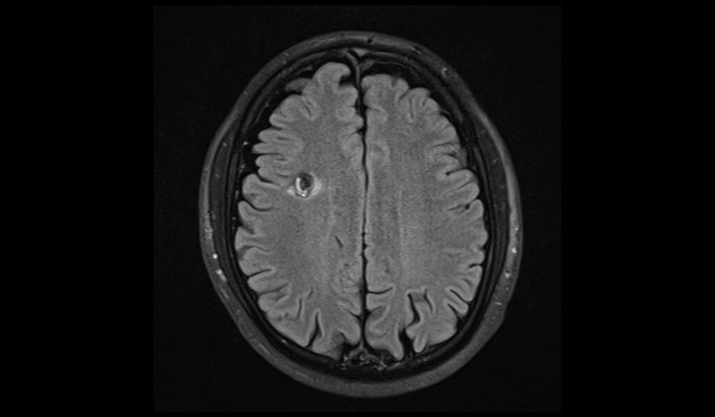 Cavernoma MRI | Radiology Article on Cavernous Hemangioma