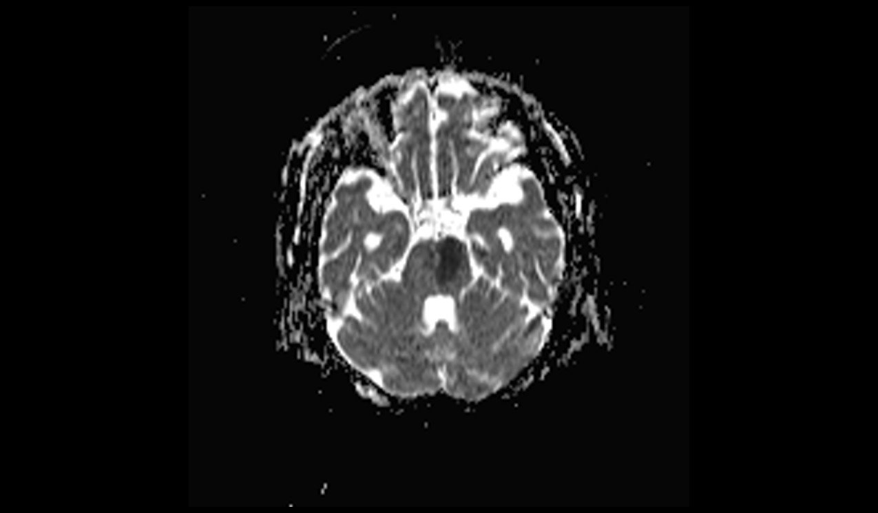 Acute Pontine Infarct MRI | Radiology Article on Acute Pontine stroke MRI