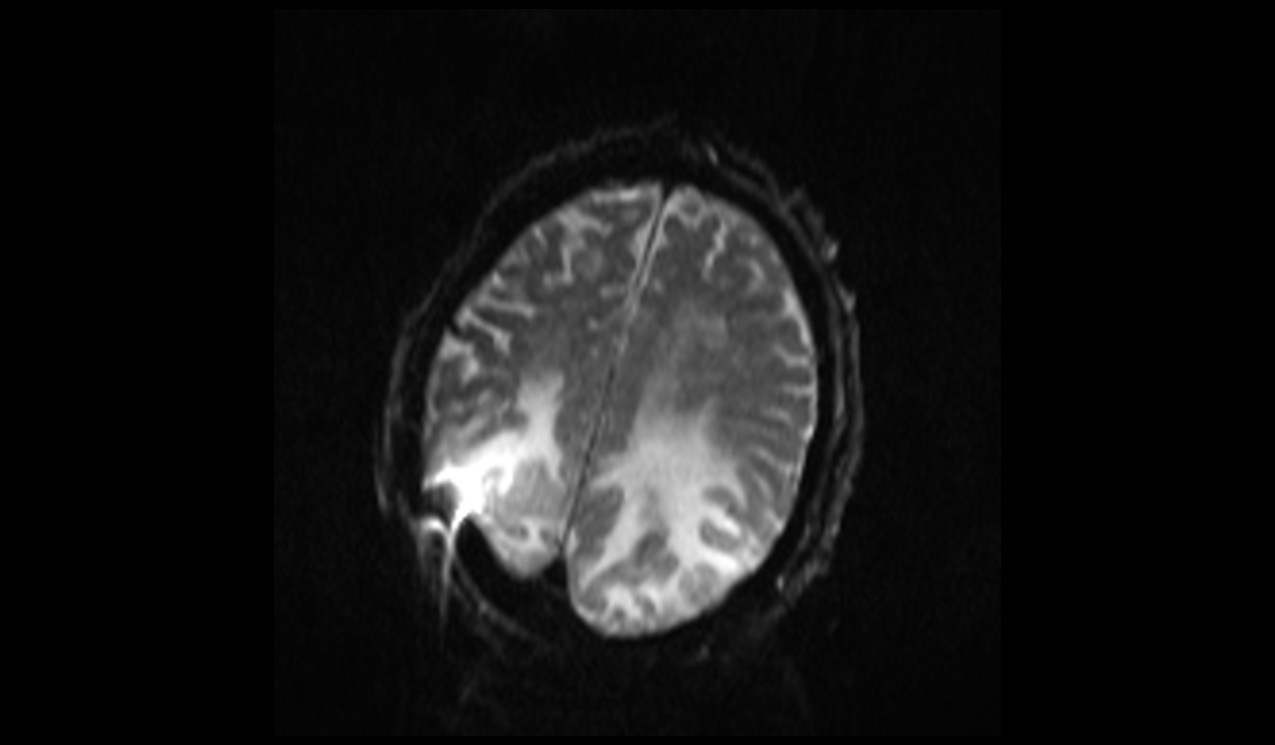 Posterior Reversible Encephalopathy Syndrome (PRES) | Radiology Article ...