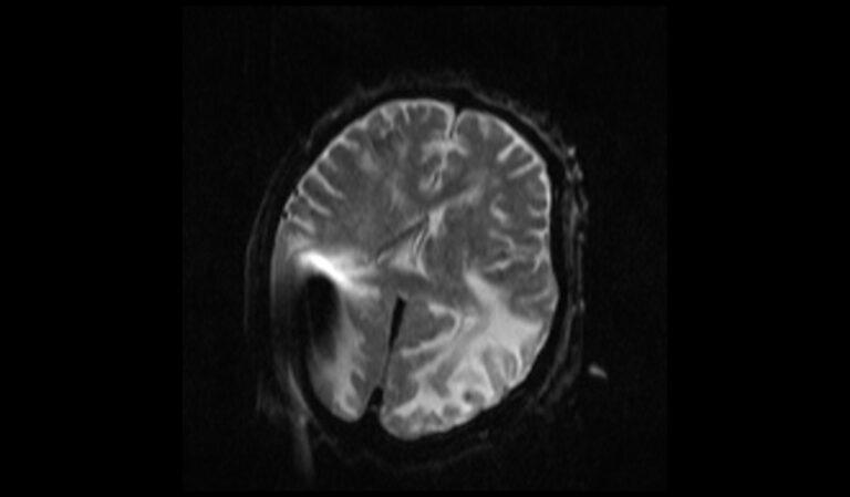 Posterior Reversible Encephalopathy Syndrome (PRES) | Radiology Article ...