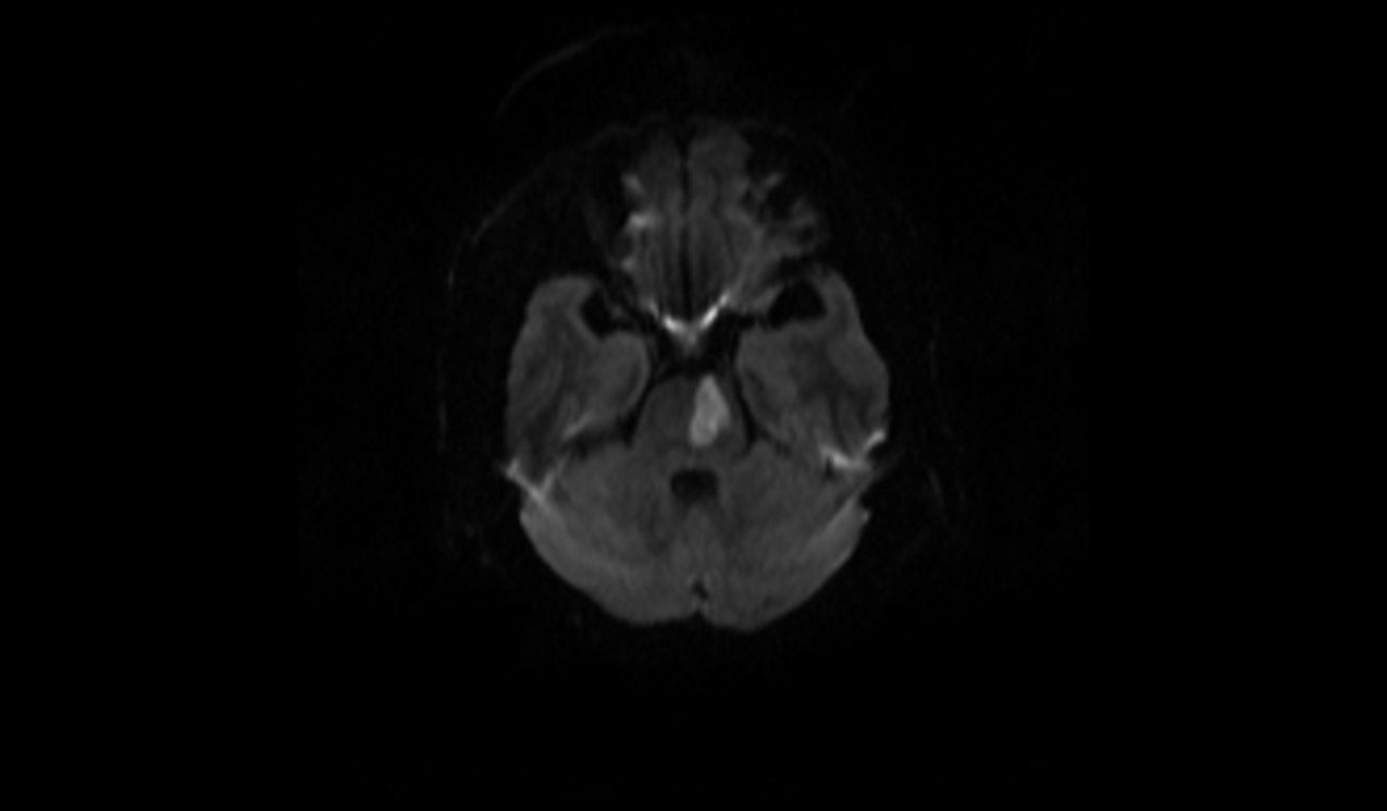 Acute Pontine Infarct MRI | Radiology Article on Acute Pontine stroke MRI