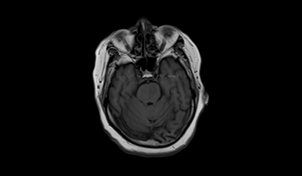 Acute Pontine Infarct MRI | Radiology Article on Acute Pontine stroke MRI