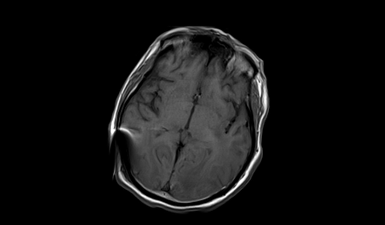 Posterior Reversible Encephalopathy Syndrome (PRES) | Radiology Article ...